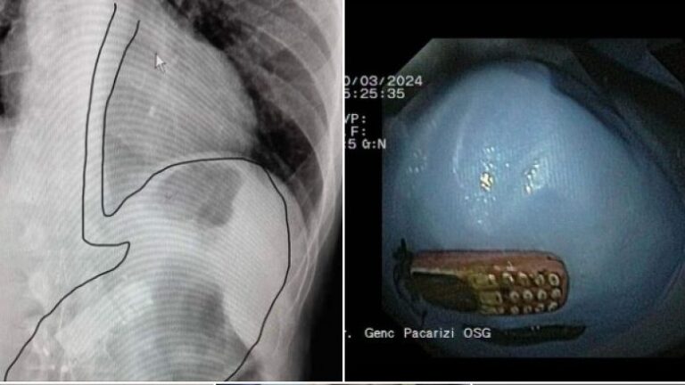 E pazakontë: Në Malishevë pacientit i largohet telefoni nga stomaku